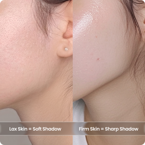 Loose Skin Creates “Pockets” for Puffiness