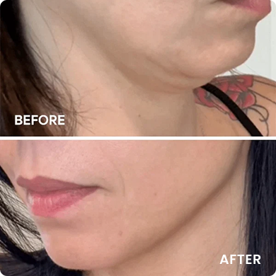 SAY GOODBYE TO YOUR DOUBLE CHIN, NO NEEDLES REQUIRED