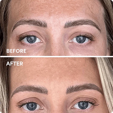 ERASES FINE LINES & WRINKLES